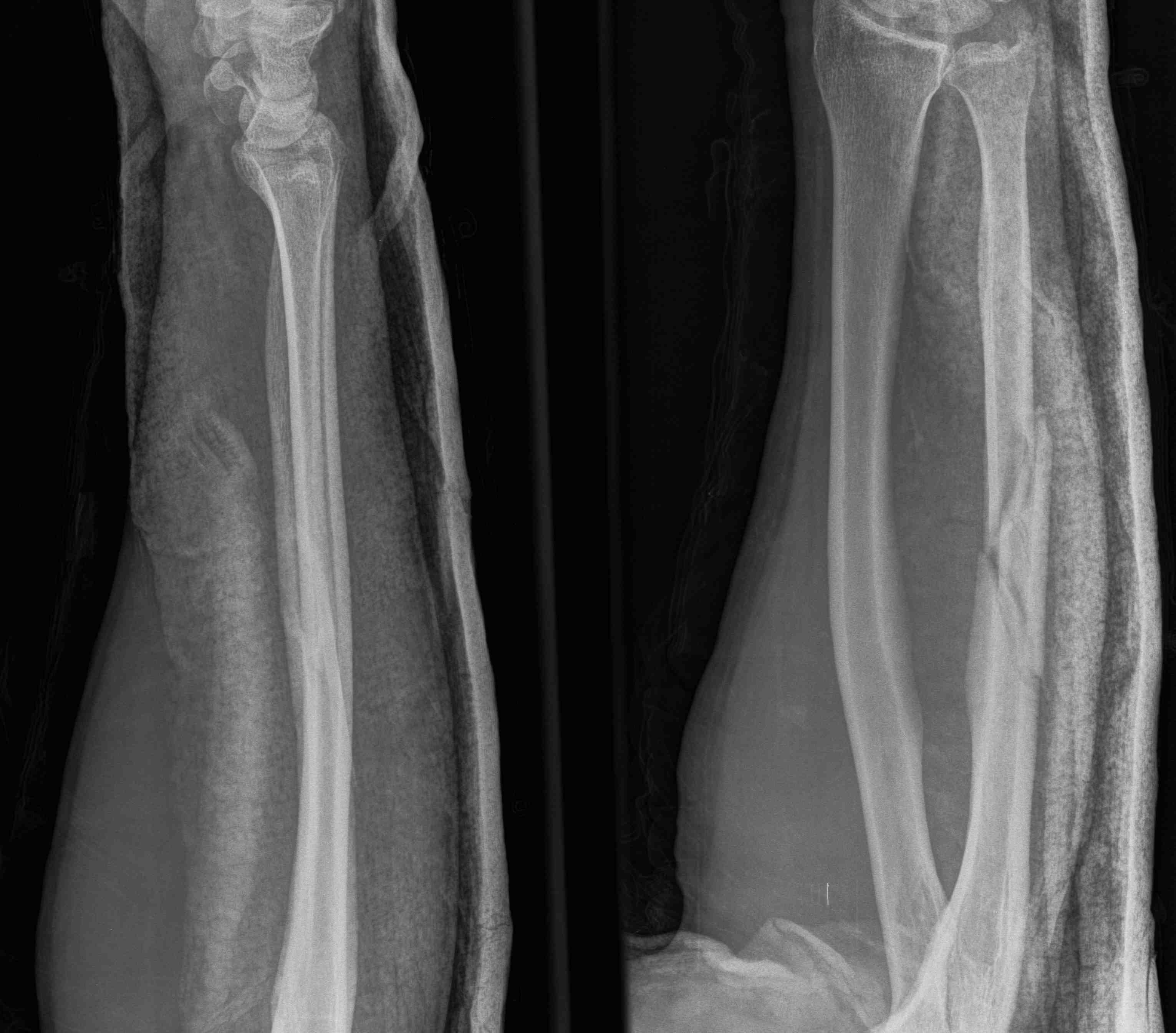 Ulna Fracture Undisplaced